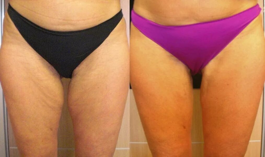 подтянутая кожа тела. как подтянуть кожу на бедрах. как подтянуть кожу на бедрах. атицеллюлитный массаж. липосакция внутренней поверхности бедра.
