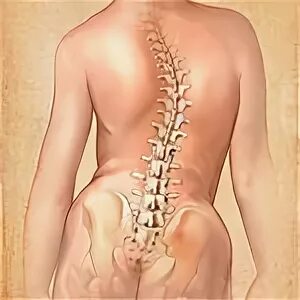 Болит спина при сколиозе. Сколиоз позвоночника. Искривленный позвоночник. Сколиоз поясничного отдела 2 степени. Искривление позвоночника в поясничном отделе.