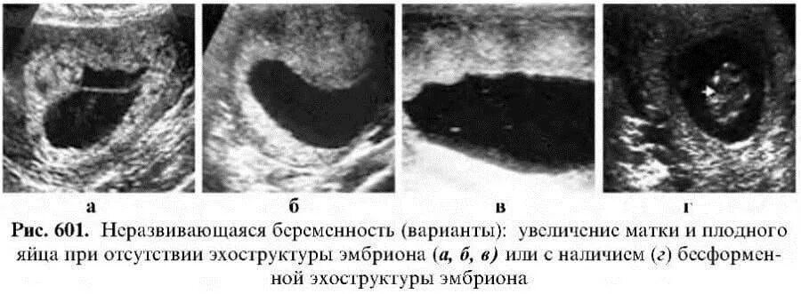 УЗИ при неразвивающейся беременности на ранних сроках. УЗИ признаки замершей беременности в 1 триместре. Неразвивающаяся беременность 7 недель УЗИ.