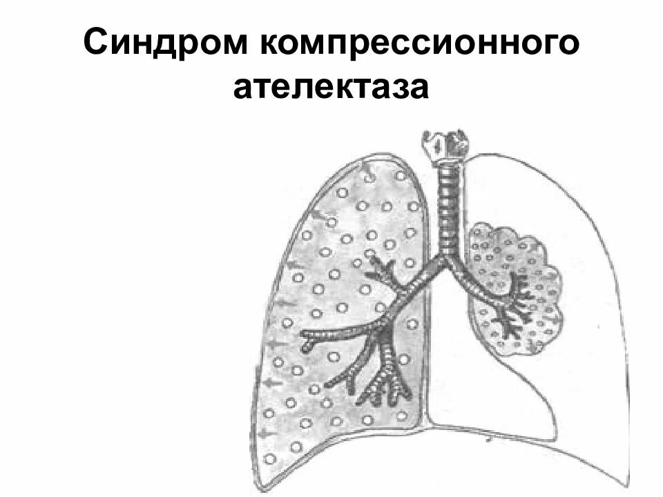 Спадение бронха