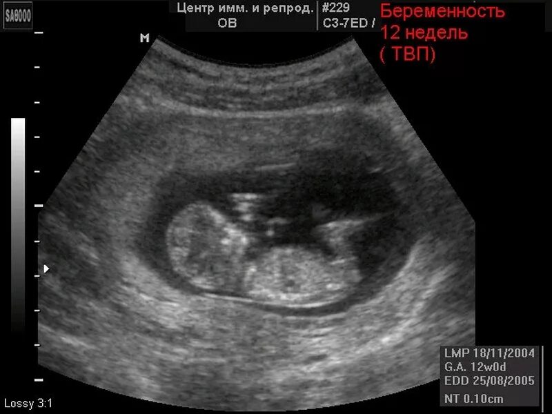 УЗИ плода на 11-12 неделе беременности. УЗИ на 12 акушерской неделе. Беременность 12 недель фото эмбриона на УЗИ. Эмбрион на 12 неделе беременности УЗИ. Тянет живот на 12 неделе