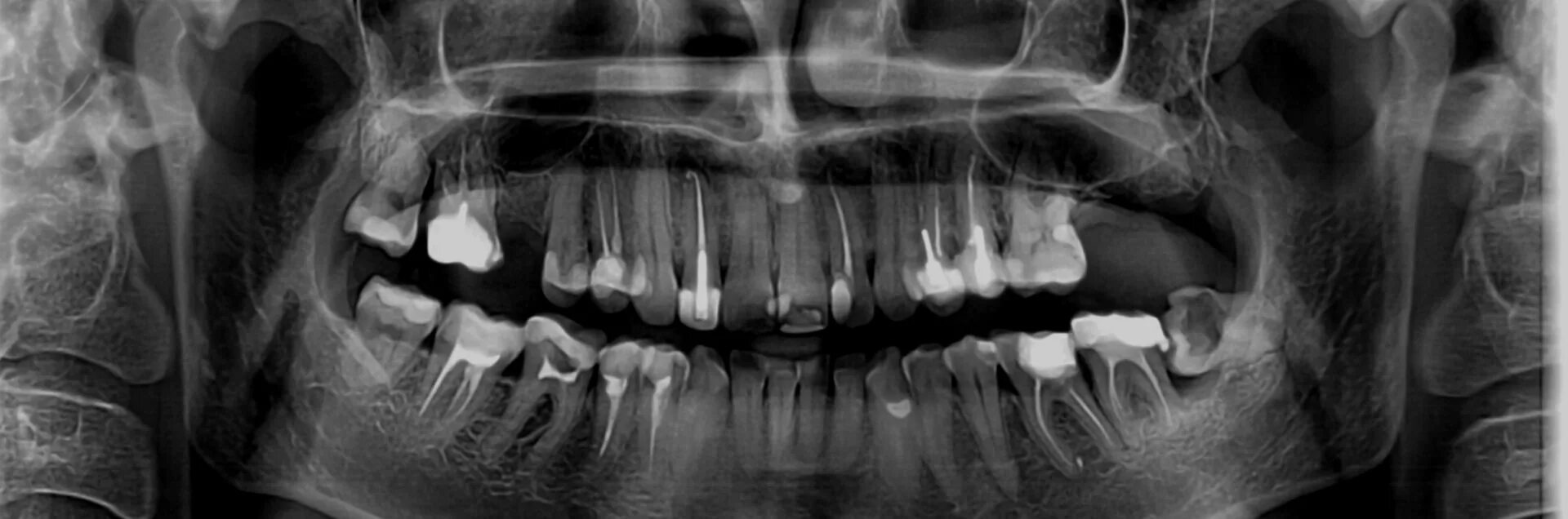 Снимок зубов видное. Ортопантомограмма кариес. Рентген зубов панорамный. Ортопантомограмма зубов. Панорамный снимок челюсти.