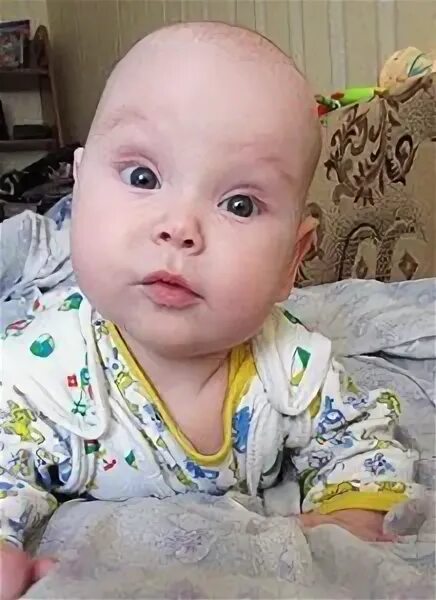 асимметрия лица у младенца. левосторонняя врожденная кривошея. кривошея у новорожденных в 4 месяца. ассиметрия головы у грудничка. ассиметрия тела у младенцев.