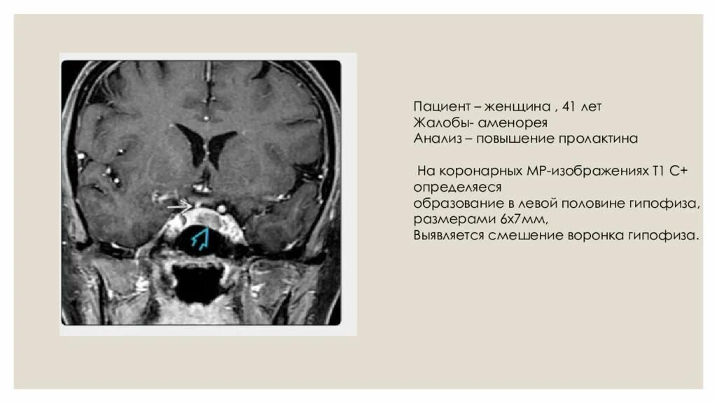 Микроаденома мрт. Аденома гипофиза кт. Микроаденома гипофиза кт. Патология воронки гипофиза мрт. Мрт при повышенном пролактине