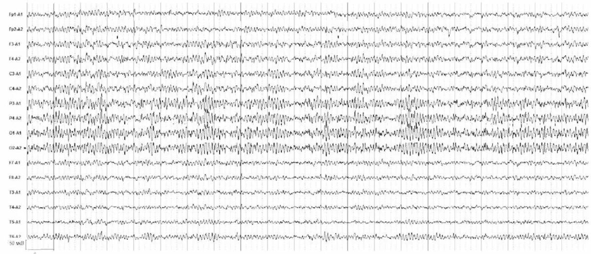 Пароксизмальная ээг. Альфа активность на ЭЭГ. Ирритативные изменения на ЭЭГ. Высокоамплитудная Дельта активность на ЭЭГ. Электроэнцефалография для водительской справки.