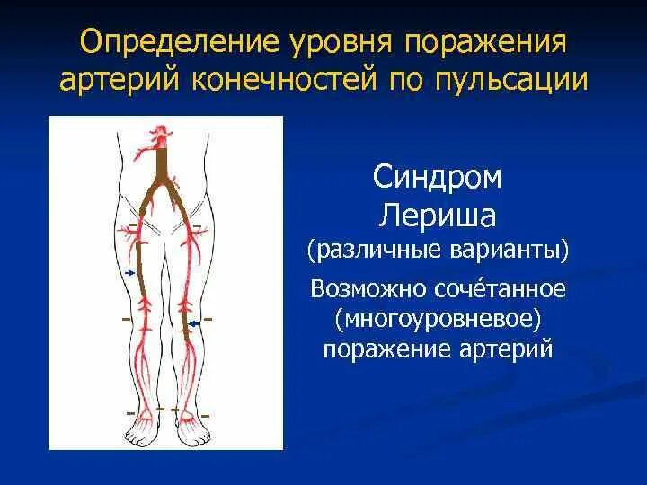 Точки определения пульсации на артериях нижних конечностей. Берцовая артерия пальпация. Тромбоз артерий нижних конечностей клинические. Облитерирующий атеросклероз артерий ног. Тромбоз подвздошной вены