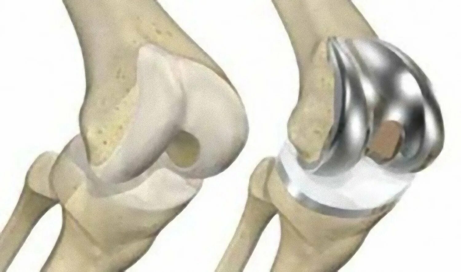 Ростов замена коленного сустава. Артропластика коленного сустава. Maxx Orthopedic эндопротез коленного. Артропластика тазобедренного сустава. Тотальное эндопротезирование коленного сустава.