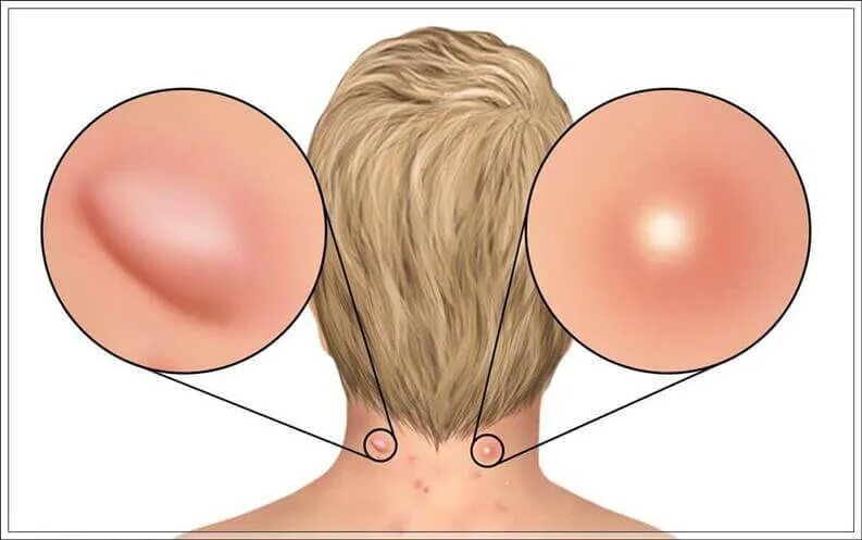 Огромный прыщ на затылке.