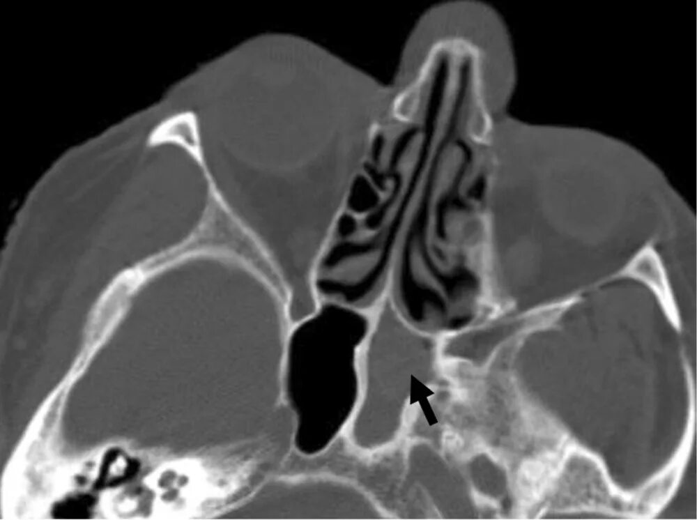 Хронический сфеноидит на кт. Кт пазух носа сфеноидит. Катаральный сфеноидит.