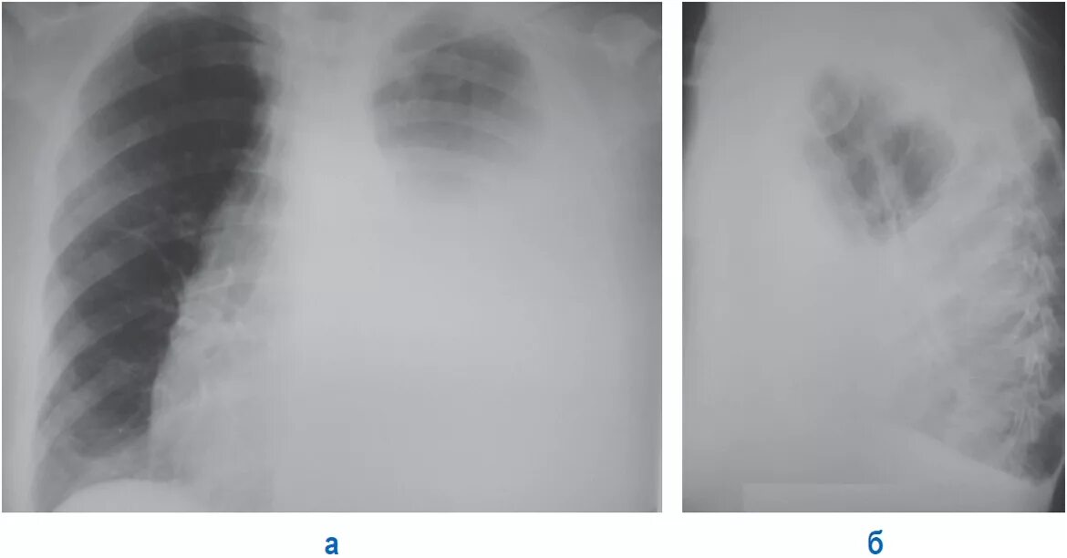 Левосторонний гидроторакс рентген. Тотальный левосторонний гидроторакс рентген. Гидроторакс легких рентгенограмма. Гидроторакс легкого рентген.