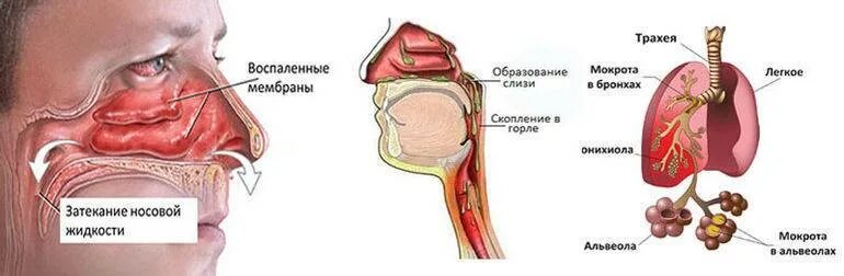 Образование мокроты. Скопление мокроты в трахее. Слизистая мокрота в горле.