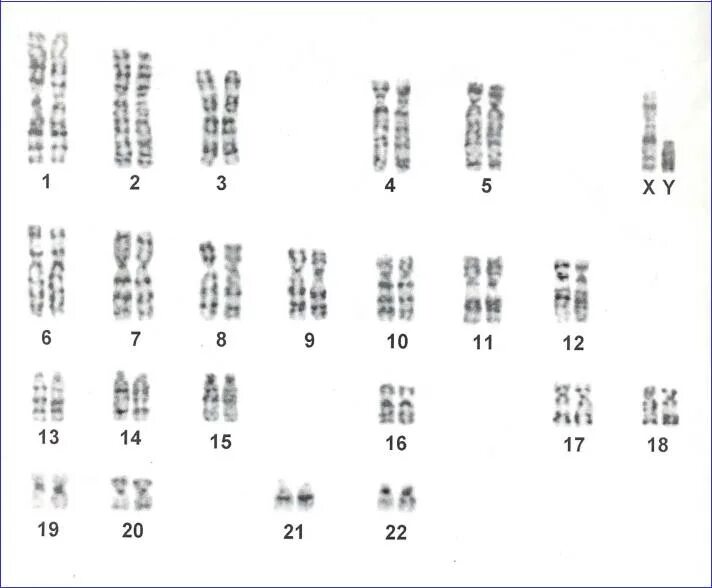 Синдром Дауна 21 хромосома. Трисомия по 21 хромосоме кариотип. Кариотип человека с синдромом Дауна. Синдром Дауна хромосомная карта. Наличие лишней хромосомы