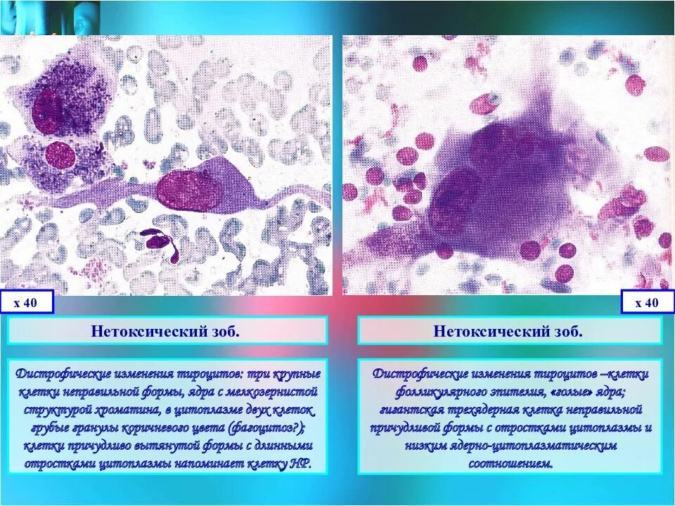 Нетоксический зоб щитовидной. Нетоксический коллоидный зоб. Клетки с ядрами неправильной формы. Пролиферирующие клетки щитовидной железы. Нетоксический коллоидно клеточный зоб.