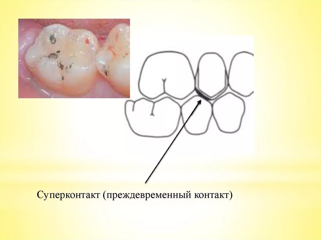 Окклюзионная прямая. Окклюзионная прямая. Основные принципы реконструкции окклюзионной поверхности:. Соотношение бугров первых моляров. Биомеханика нижней челюсти внчс.