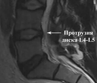 Протрузия диска l4 l5 что это такое