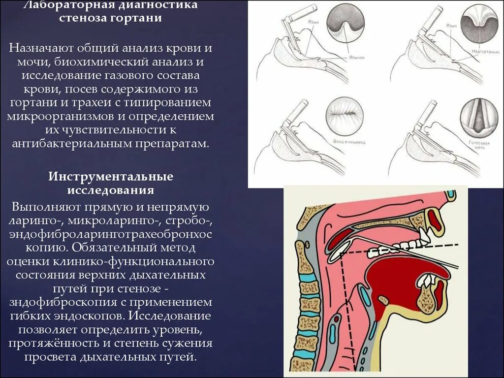 Чувствительность глотки. Подострый стеноз гортани. Острый стеноз гортани классификация. Субкомпенсированный стеноз гортани.