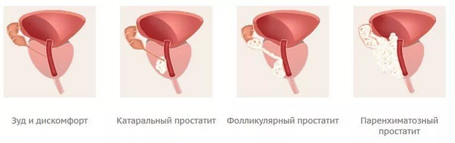 Форма простаты