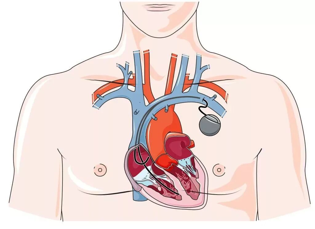 Сердечный кардиостимулятор. Имплантируемый кардиостимулятор. Операция кардиостимулятор сердца. Имплантируемые кардиовертеры-дефибрилляторы.