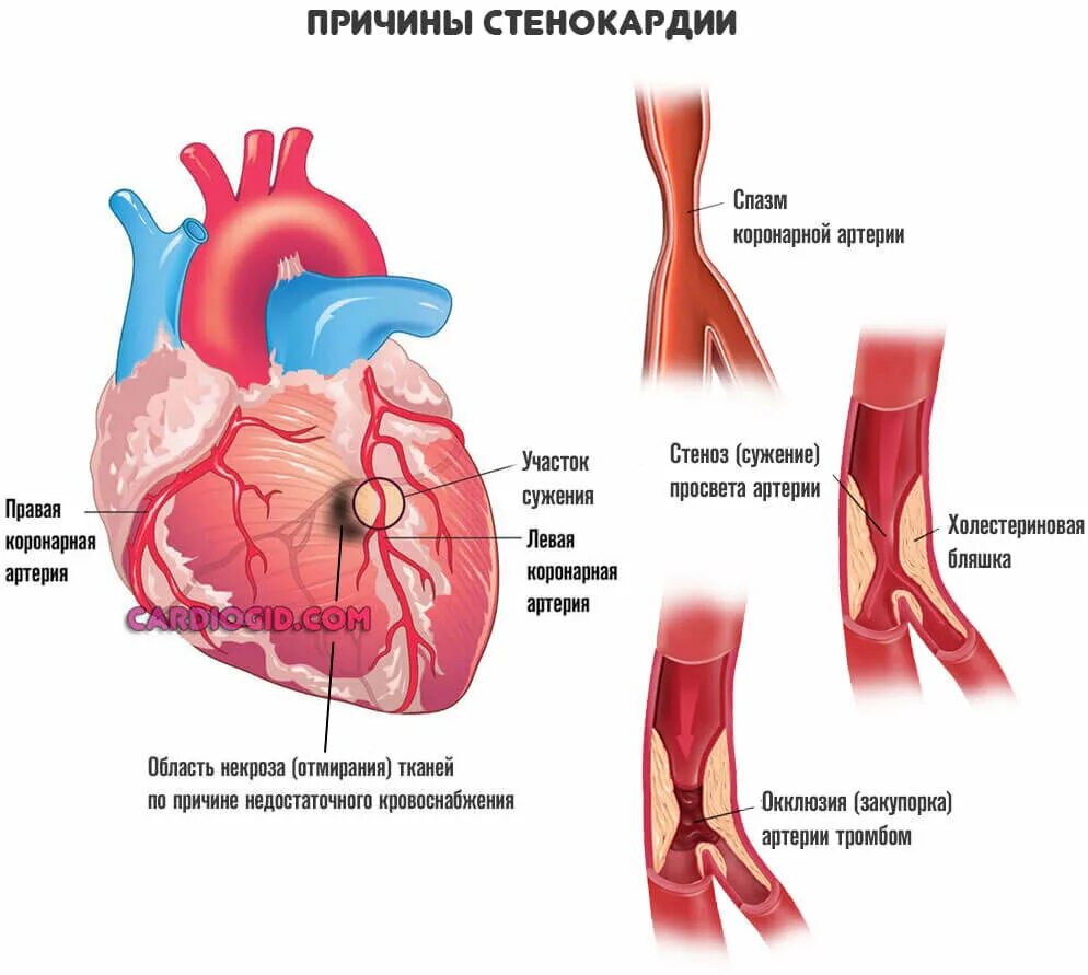 Нестабильная стенокардия. Аортальная стенокардия. Аортальная стенокардия. Аортальная стенокардия. Стенокардия грудная жаба.