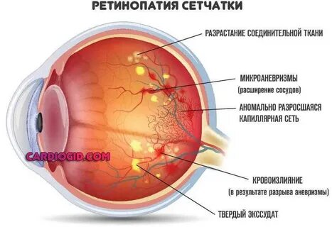 Миопия ангиопатия