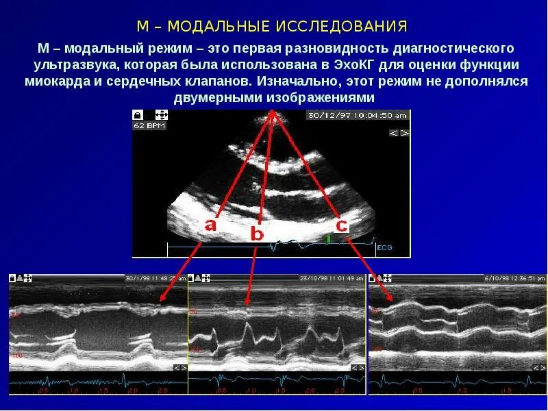 Как проходят эхо. Методика проведения эхокардиографии. Основы ЭХОКГ. Эхокардиография метод исследования. Эхокардиография суть метода.