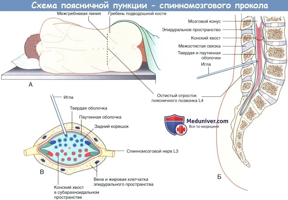 Техника проведения люмбальной пункции алгоритм. Техника спинномозговой пункции алгоритм. Пункция спинномозговой жидкости техника. Положение больного после люмбальной пункции.