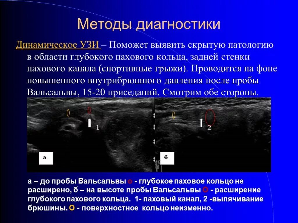 Скрытая патология. Пахово-мошоночная грыжа на УЗИ протокол. УЗИ паховой грыжи заключение. Паховые грыжи на УЗИ описание.