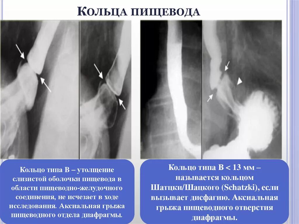 Пищевод шацкого. Грыжа пищеводного отверстия диафрагмы ФГДС. Рентгенодиагностика грыжи пищеводного. Грыжа диафрагмы пищевода рентген. Аксиальная грыжа пищевода рентген.