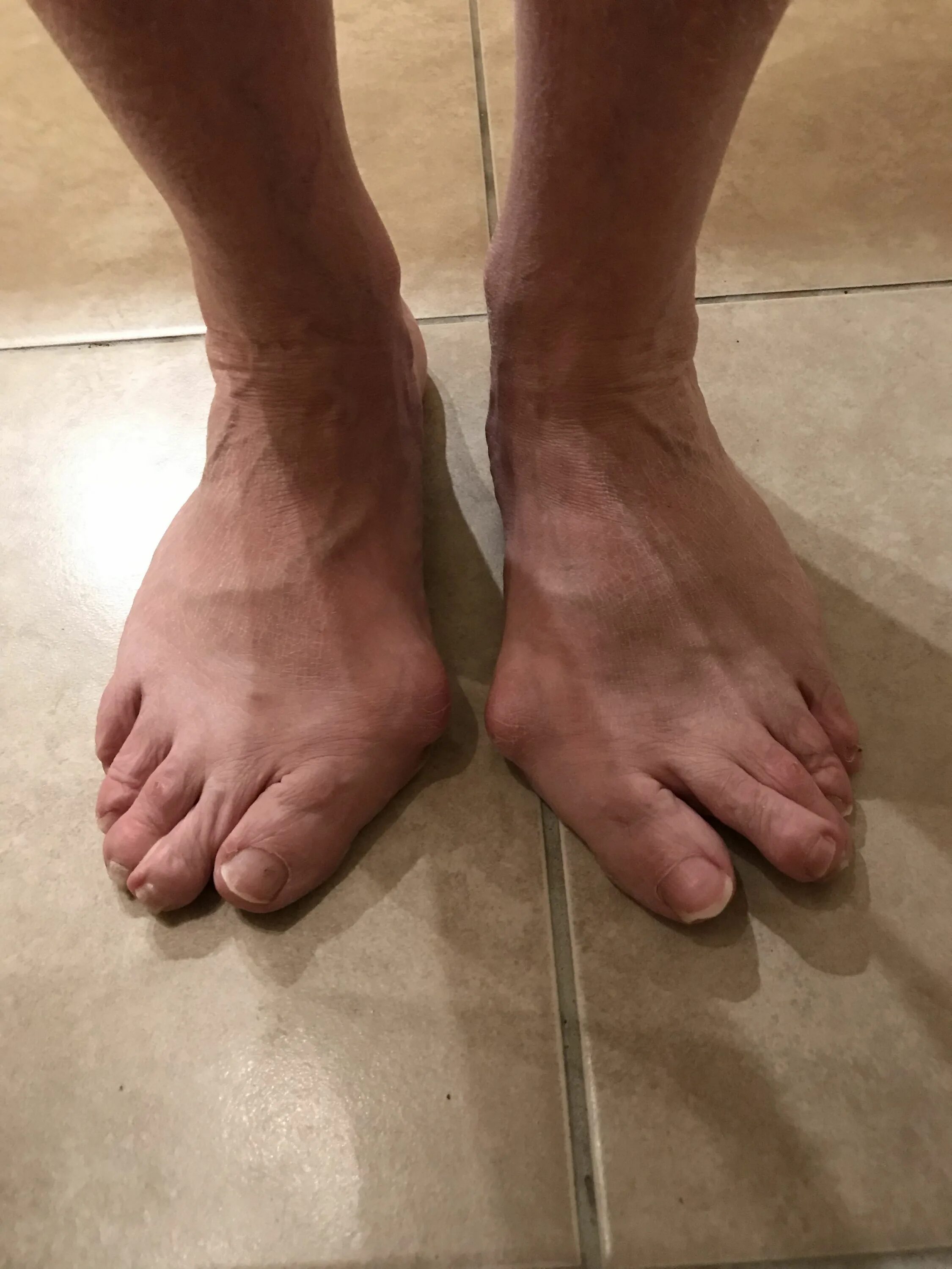 широкая стопа ноги