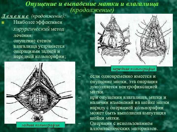 Опущение матки и выпадение матки. Выпадение свода влагалища. Пролапс купола влагалища. Опущена передняя стенка влагалища. Опущение матки после 60 лет