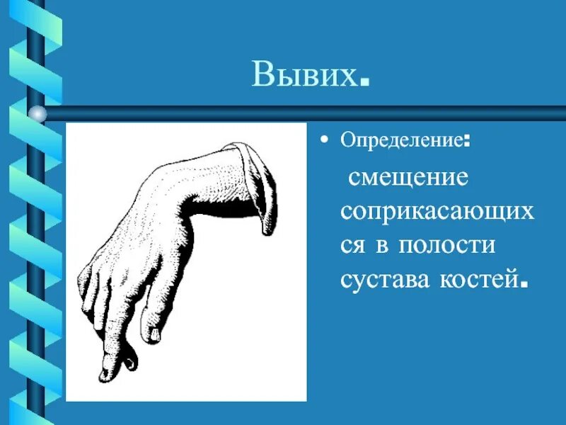 Вывих определение. Вывих сустава определение.