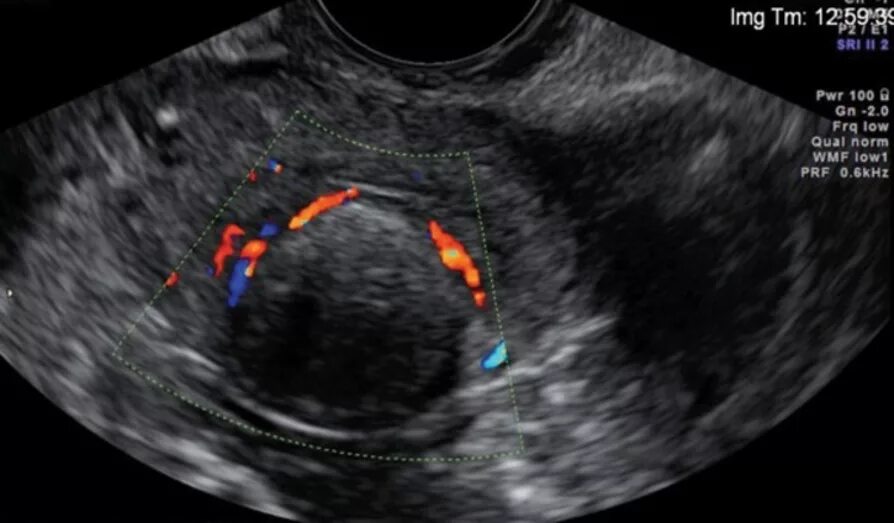Интрамуральная миома матки УЗИ. Миома матки допплерография.