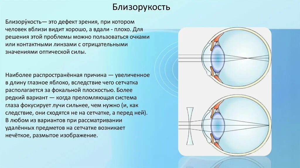 Плохо вижу вдали. Дефекты зрения близорукость. Дефекты зрения физика. Дефекты зрения картинки. Близорукость это видеть вблизи.