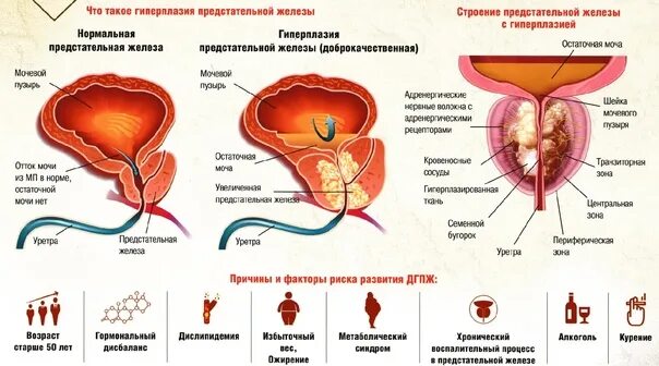 Гиперплазия предстательной железы препараты. Стадии гиперплазии предстательной железы. Гиперплазия предстательной железы симптомы.