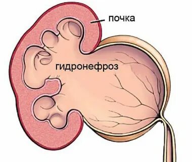 Расширенная лоханка почки лечение