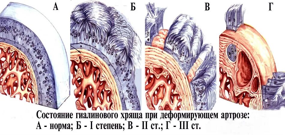 Изменение хряща. Возрастные изменения хряща. возрастные изменения гиалинового хряща. остеоартроз гиалинового хряща.