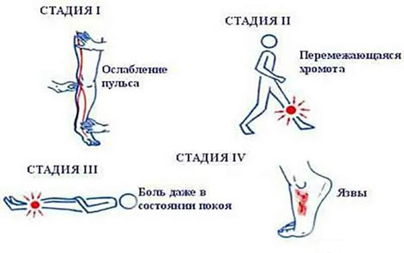 Почему хромает нога. Венозная недостаточность трофическая язва. Венозная трофическая язва нижних конечностей. Трофическая язва классификация язв. Трофические язвы на варикозных венах.