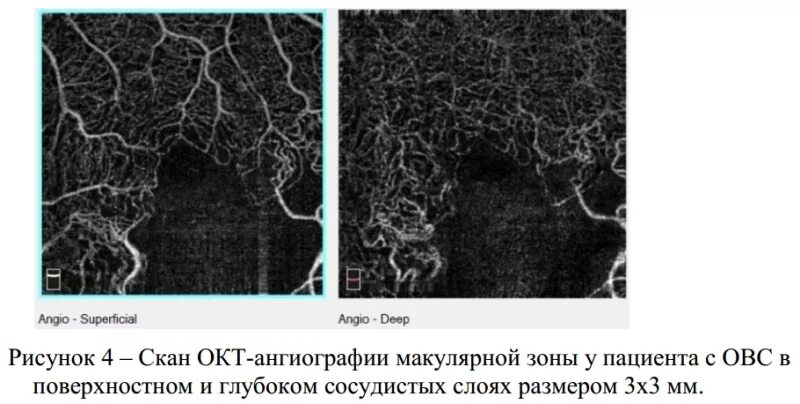 Ангио окт. Ангио окт