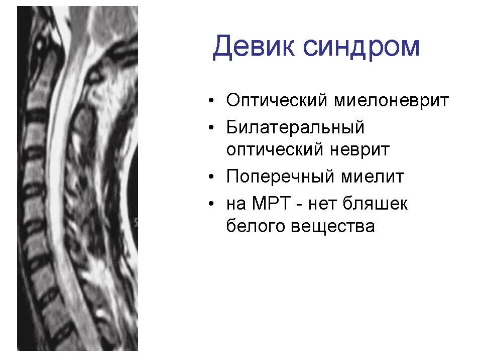 Болезнь девика что это такое. Оптикомиелита девика. оптиконевромиелит девика. оптикомиелит девика симптомы. острый поперечный миелит мрт.
