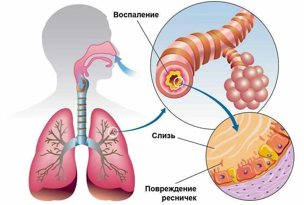 Усиленная мокрота. Поражение бронхов острый бронхит. Хронический бронхит симптомы дыхание. Острый и хронический бронхит.