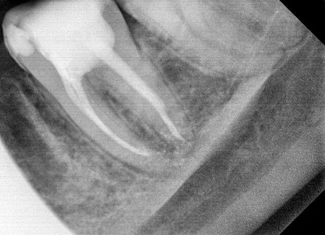 Плохо запломбированный канал. Прицельный снимок запломбированного зуба. Зуб запломбирован не до конца. Рентген пломбировки зуба 14.