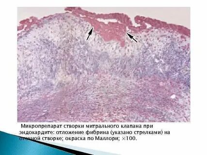 Фибринозный перикардит микропрепарат