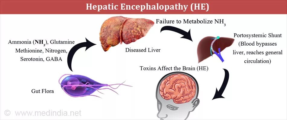 Головной мозг печень кровь. Патогенетическая терапия печеночной энцефалопатии. Синдром печеночной энцефалопатии. Синдром печеночной энцефалопатии патогенез. Печеночная энцефалопатия фото.