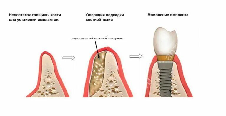 Через сколько можно есть после установки имплантов. Наращивание костной ткани для имплантов.