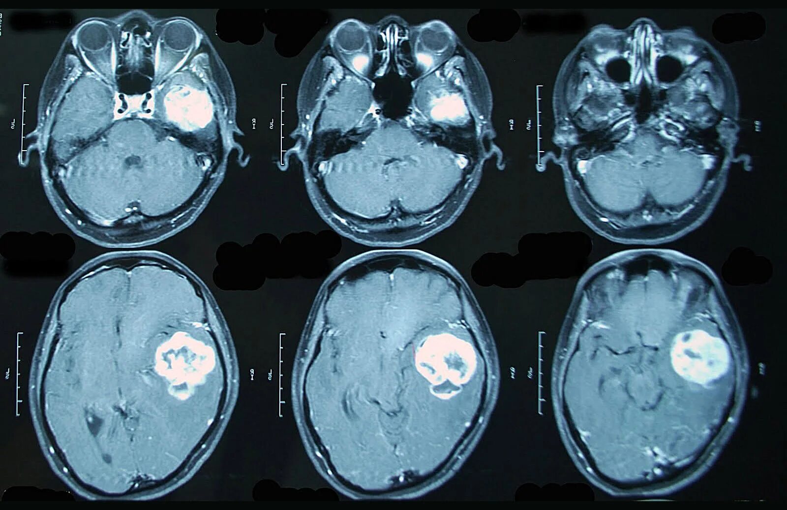 Мрт с контрастом головного. Глиома головного мозга кт. Магнитно-резонансные томограммы головного мозга с опухолью. Опухоль головного мозга мрт. Компьютерная томография головного мозга опухоль.