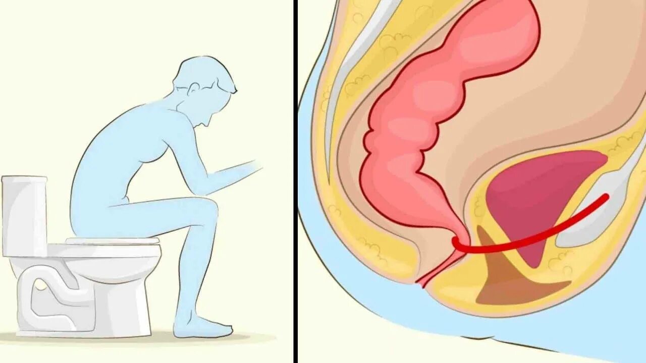 При дефекации кишка. Правильная поза для туалета. Поза для дефекации. Правильная поза для каканья. Правильная поза для опорожнения.