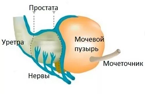 Удаление мочевого пузыря сколько. Удаленный мочевой пузырь. Удаление мочевого пузыря и простаты. Цистэктомия мочевого пузыря у мужчин.