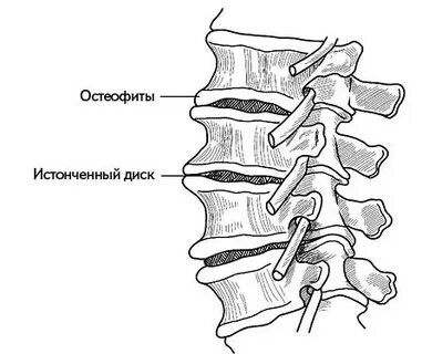 Остеофиты операция