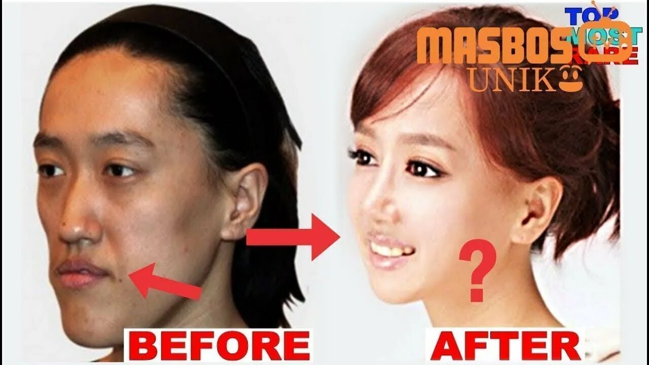 Южная Корея пластическая хирургия. Китай пластика девушка. Korean man Plastic Surgery.