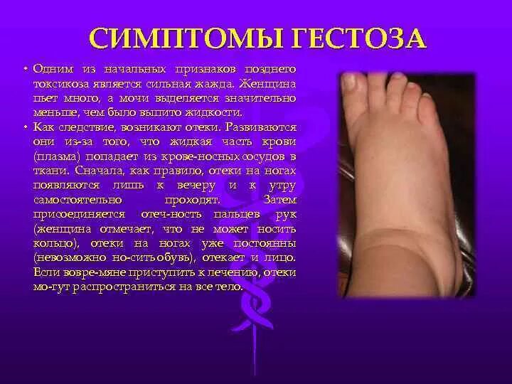 Отекают ноги 3 триместр. Гестоз при беременности 2 триместр симптомы. поздний гестоз при беременности симптомы. гестац при беременность. кистоз при беременности.